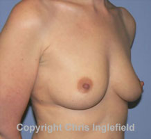 Breasts Before Macrolane Treatment