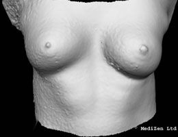 Digital Imaging of Breast After Macrolane Treatment