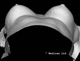 Digital Imaging of Breast After Macrolane Treatment