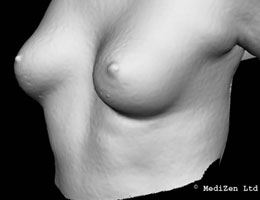 Digital Imaging of Breast After Macrolane Treatment