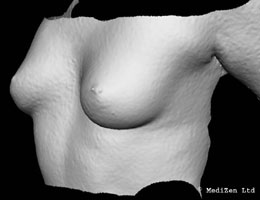 Digital Imaging of Breast Before Macrolane Treatment