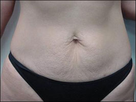 Abdomen after treatment with Tripollar