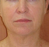After EndyMed Radiofrequency treatment