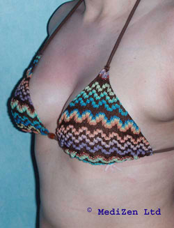 Breasts After Macrolane Treatment