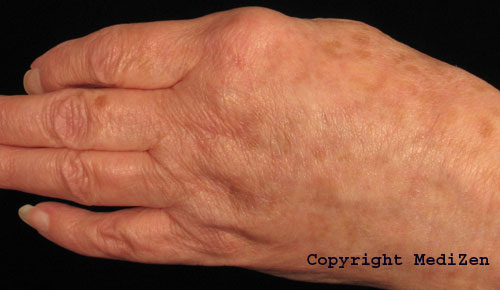 After treatment with Radiesse for hand ageing