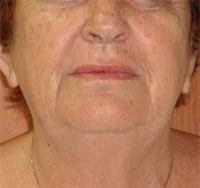 After EndyMed Radiofrequency treatment