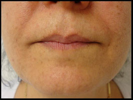 Female With Pigmentation Associated With Sun Damage Acne After CosMedix Peel Treatment