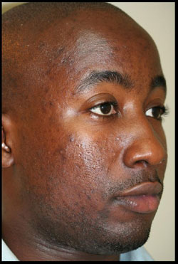 Male After Programme of CosMedix Peel Treatments - Side of Face