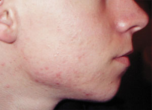 Acne - after Agera Rx Peel treatment