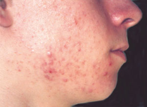 Acne - before Agera Rx Peel treatment