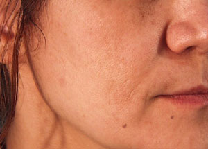 Hyperpigmentation - after Agera Rx Peel treatment