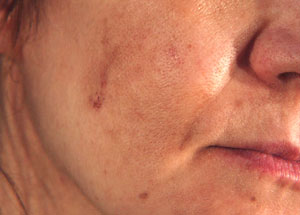 Hyperpigmentation - before Agera Rx Peel treatment