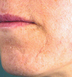 Age related scarring - after Agera Rx Peel treatment