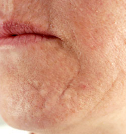 Age related scarring - before Agera Rx Peel treatment