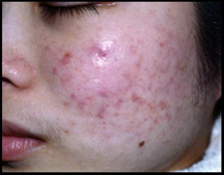 Asian (Oriental) Female With Acne Before CosMedix Peel Treatment