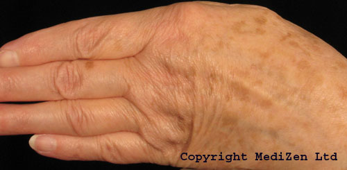 Before Radiesse Hand Rejuvenation