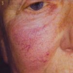 A picture of a cheek before having the veinwave treatment