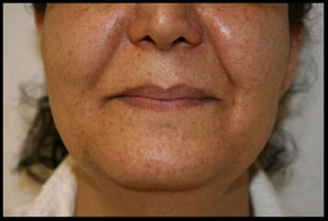 Female With Pigmentation Associated With Sun Damage Acne Before CosMedix Peel Treatment