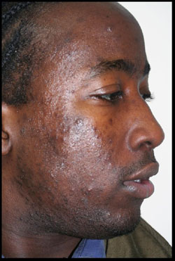 Male With Acne Before CosMedix Peel Treatment - Side of Face