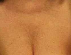 Female, décolletage 6 weeks post treatment with Belotero®.