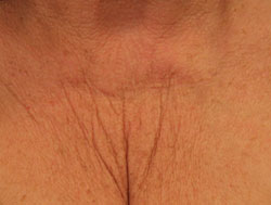 Female, décolletage before treatment.
