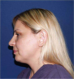 Face before Tripollar treatment