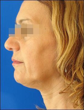 Face before Tripollar treatment