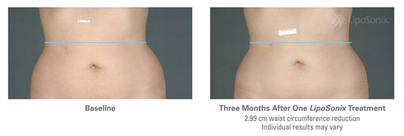 Before and After Liposonix Treatments