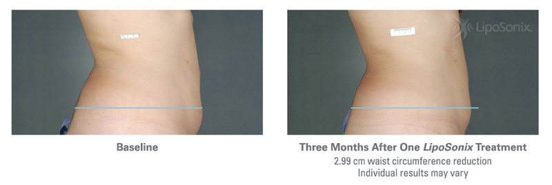 Before and After Liposonix Treatments