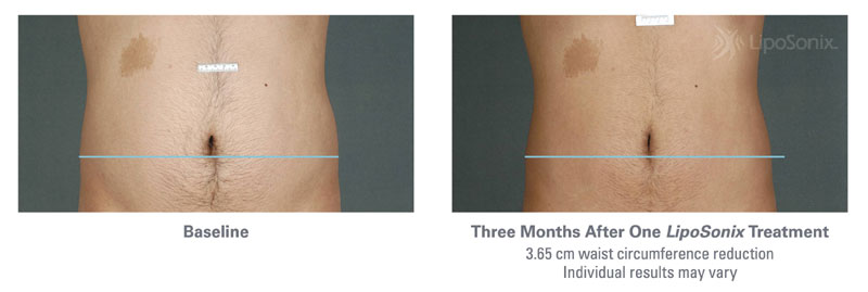 Before and After Liposonix Treatments