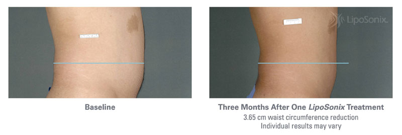 Before and After Liposonix Treatments