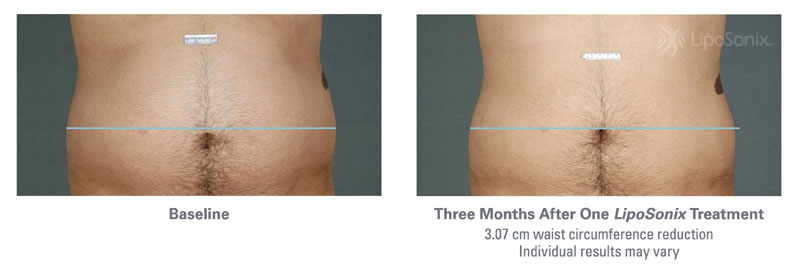 Before and After Liposonix Treatments