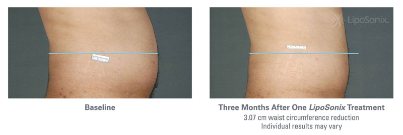 Before and After Liposonix Treatments