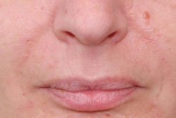 Nasolabial folds immediately after treatment with Belotero