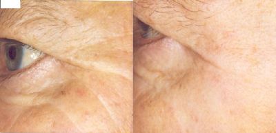58 Year old male before and after Omnilux