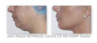 Before and After Treatment with Osyris Pharaon Lipo Laser
