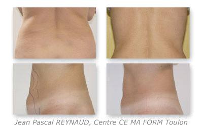 Before and After Treatment with Osyris Pharaon Lipo Laser