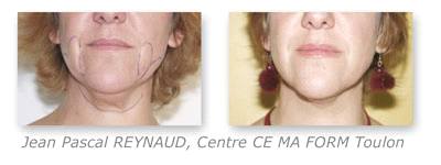 Before and After Treatment with Osyris Pharaon Lipo Laser