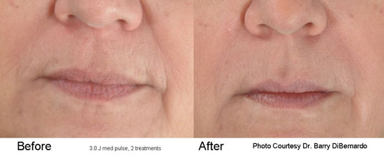 Before and After two treatments with the Pearl YSGG Laser