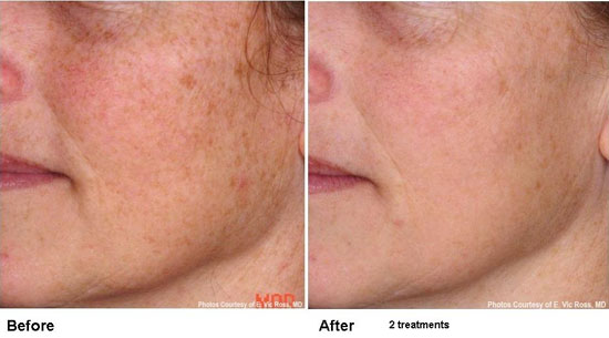 Before and After two treatments with the Pearl YSGG Laser