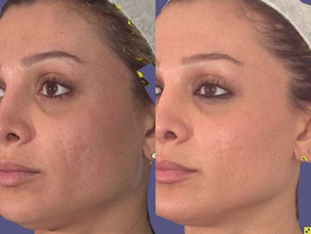 Before and After -  Scarring Treated with Pixel Laser