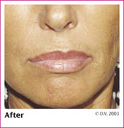 After Treatment with Sculptra