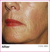 After Treatment with Sculptra