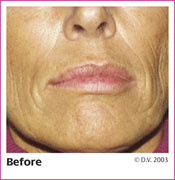 Before Treatment with Sculptra