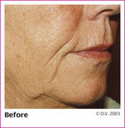 Before Treatment with Sculptra