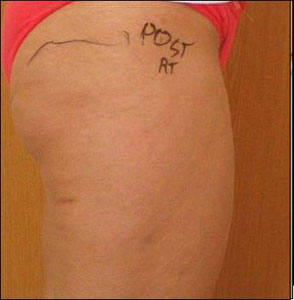 Thigh after treatment with Tripollar
