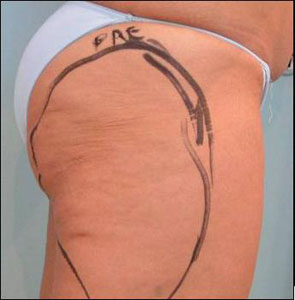 Thigh before treatment with Tripollar