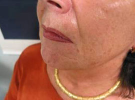 Skin surface, nasolabial folds and marionette lines after treatment with Varioderm