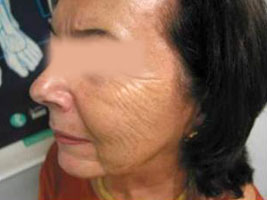 Nasolabial folds and marionette lines before Varioderm treatment