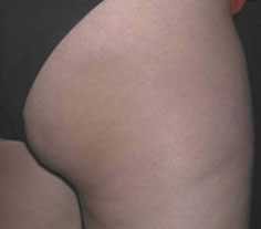 Cellulite after treatment with Accent